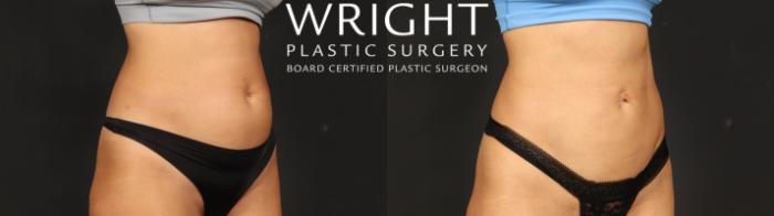 Before & After Liposuction Case 636 Right Oblique View in Little Rock, Arkansas