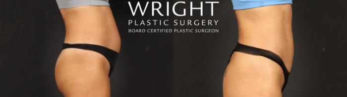 Before & After Liposuction Case 636 Right Side View in Little Rock, Arkansas