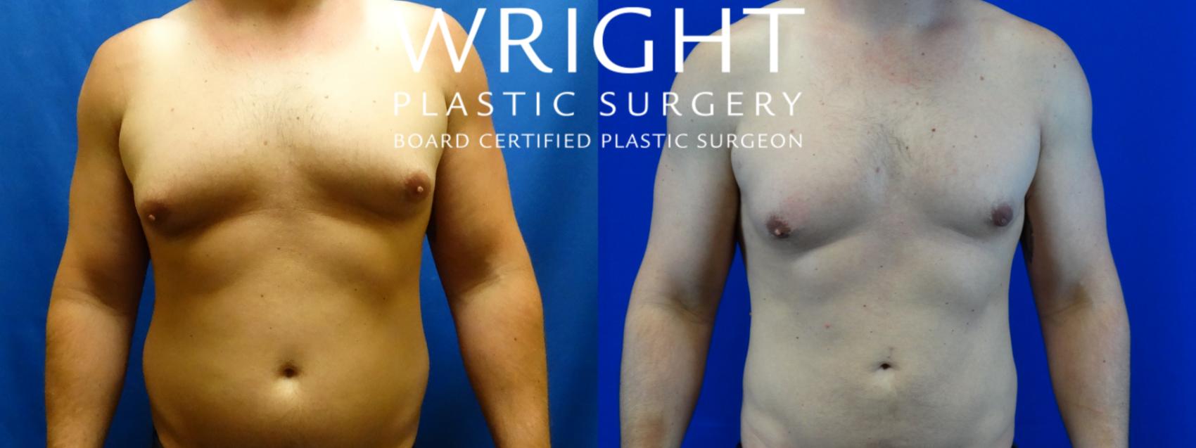 Before & After Male Breast Reduction Case 118 Front View in Little Rock, Arkansas