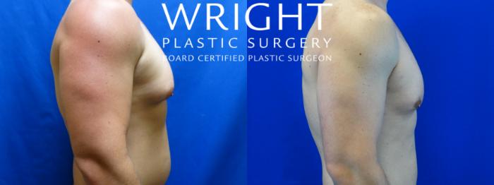 Before & After Male Breast Reduction Case 118 Right Side View in Little Rock, Arkansas