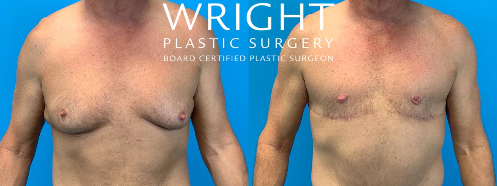 Before & After Male Breast Reduction Case 197 Front View in Little Rock, Arkansas