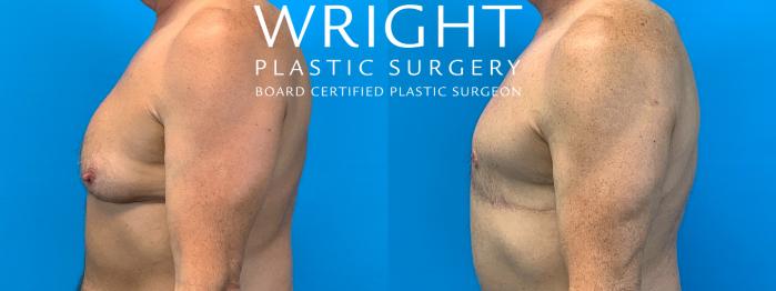 Before & After Male Breast Reduction Case 197 Left Side View in Little Rock, Arkansas