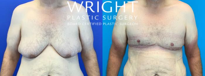 Before & After Male Breast Reduction Case 254 Front View in Little Rock, Arkansas