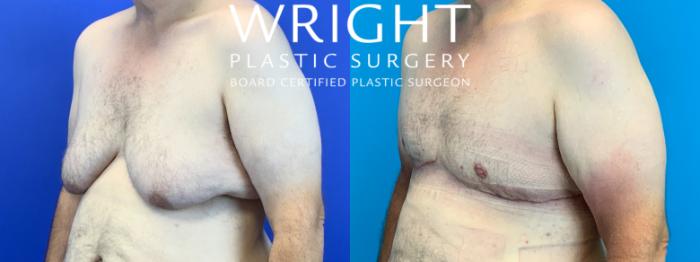 Before & After Male Breast Reduction Case 254 Left Oblique View in Little Rock, Arkansas