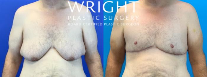 Before & After Male Breast Reduction Case 266 Front View in Little Rock, Arkansas