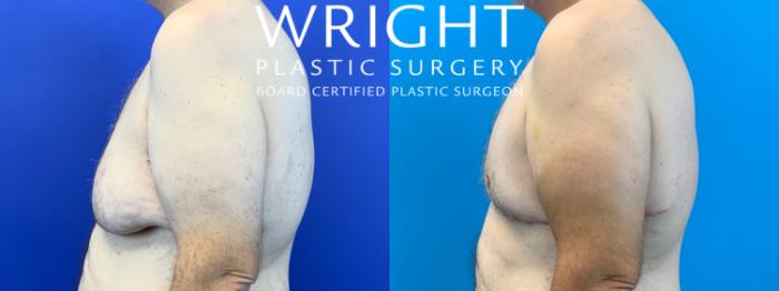 Before & After Male Breast Reduction Case 266 Left Side View in Little Rock, Arkansas