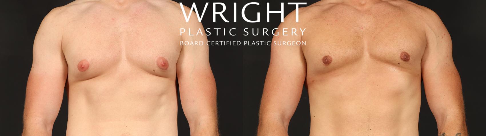 Before & After Male Breast Reduction Case 657 Front View in Little Rock, Arkansas
