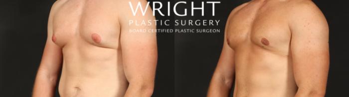 Before & After Male Breast Reduction Case 657 Left Oblique View in Little Rock, Arkansas
