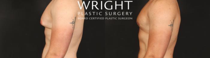 Before & After Male Breast Reduction Case 657 Left Side View in Little Rock, Arkansas