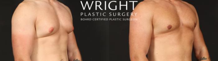 Before & After Male Breast Reduction Case 657 Right Oblique View in Little Rock, Arkansas