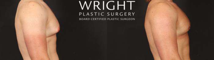 Before & After Male Breast Reduction Case 657 Right Side View in Little Rock, Arkansas