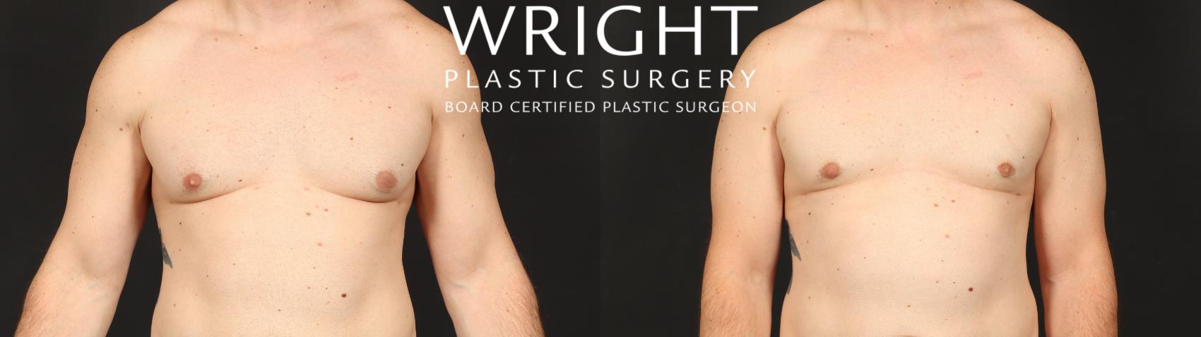 Before & After Male Breast Reduction Case 660 Front View in Little Rock, Arkansas