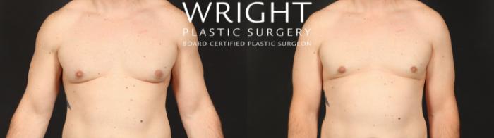 Before & After Male Breast Reduction Case 660 Front View in Little Rock, Arkansas