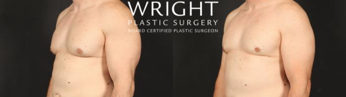 Before & After Male Breast Reduction Case 660 Left Oblique View in Little Rock, Arkansas