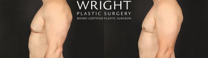Before & After Male Breast Reduction Case 660 Left Side View in Little Rock, Arkansas