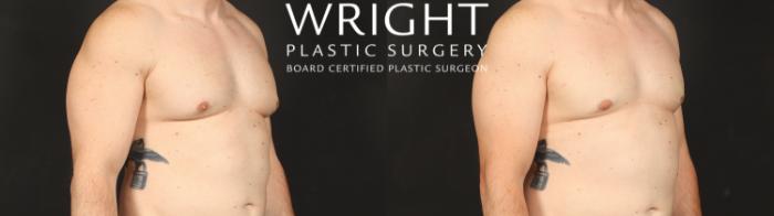 Before & After Male Breast Reduction Case 660 Right Oblique View in Little Rock, Arkansas