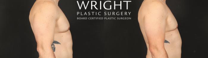Before & After Male Breast Reduction Case 660 Right Side View in Little Rock, Arkansas