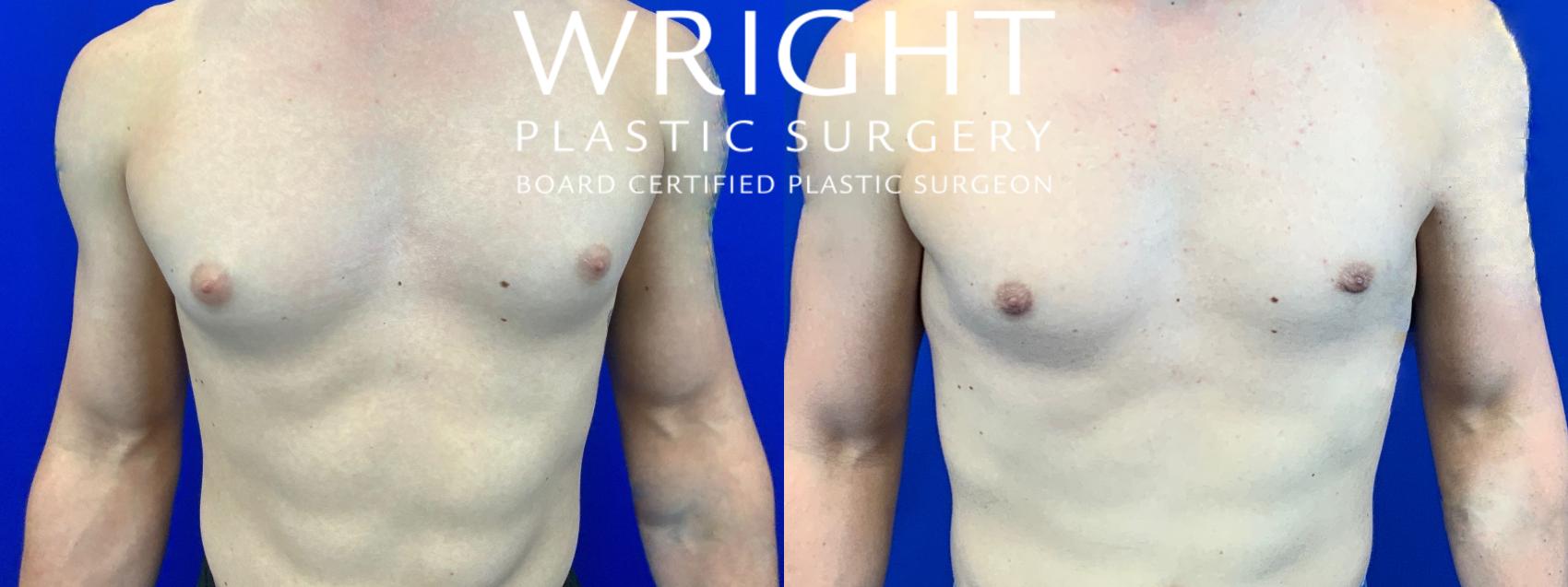 Before & After Male Breast Reduction Case 96 Front View in Little Rock, Arkansas