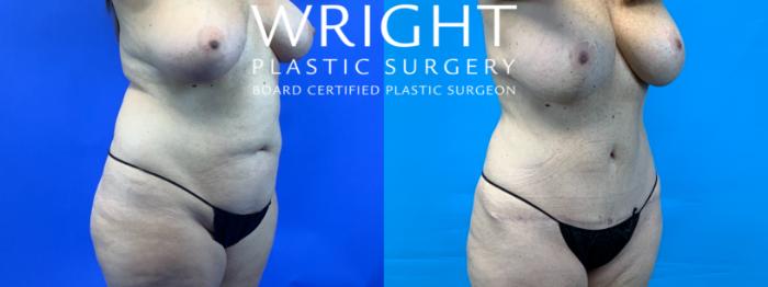 Before & After Liposuction Case 137 Right Oblique View in Little Rock, Arkansas