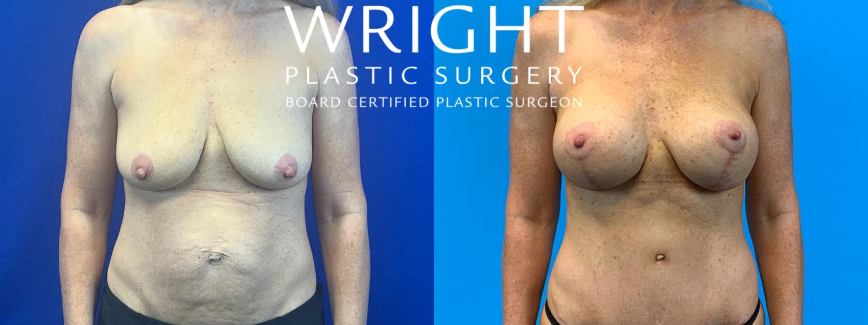 Before & After Tummy Tuck Case 142 Front View in Little Rock, Arkansas