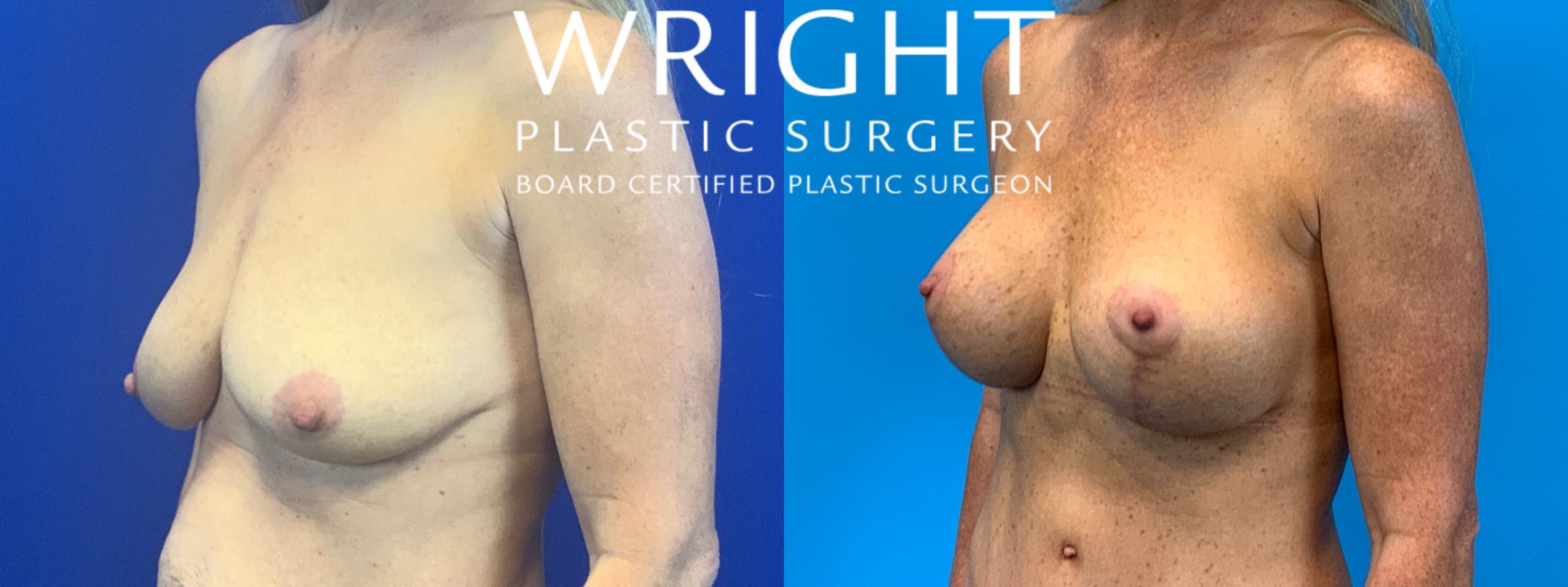 Before & After Breast Augmentation Case 143 Left Oblique View in Little Rock, Arkansas
