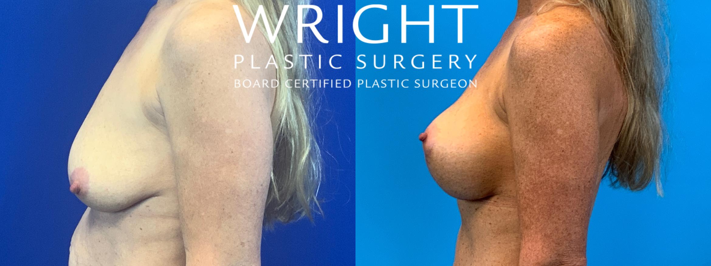 Before & After Breast Augmentation Case 143 Left Side View in Little Rock, Arkansas