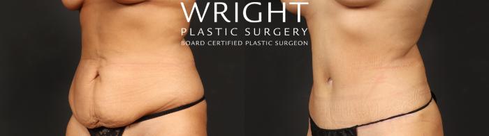 Before & After Mommy Makeover Case 684 Left Oblique View in Little Rock, Arkansas