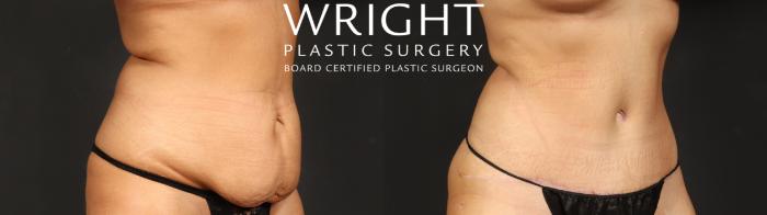Before & After Mommy Makeover Case 684 Right Oblique View in Little Rock, Arkansas