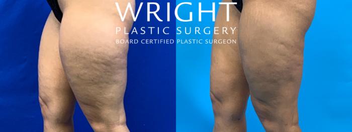Before & After Liposuction Case 194 Left Oblique View in Little Rock, Arkansas