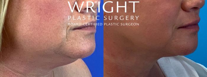 Before & After Renuvion Case 218 Face Right View in Little Rock, Arkansas