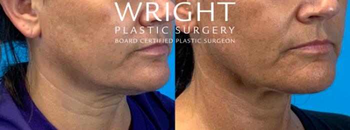 Before & After Renuvion Case 310 Right Oblique View in Little Rock, Arkansas