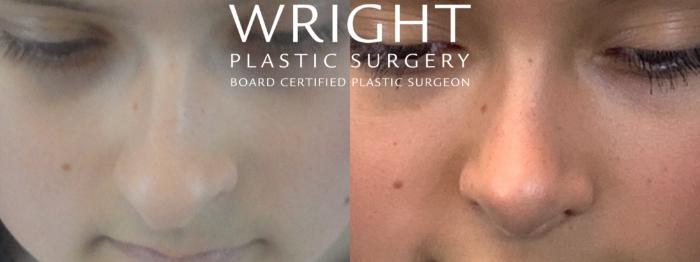Before & After Rhinoplasty Case 145 Face Down View in Little Rock, Arkansas