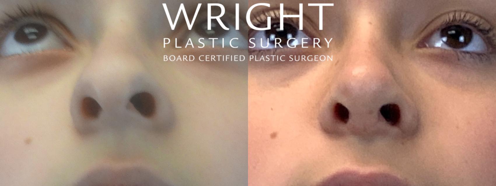 Before & After Rhinoplasty Case 145 Face Up View in Little Rock, Arkansas