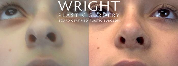 Before & After Rhinoplasty Case 145 Face Up View in Little Rock, Arkansas