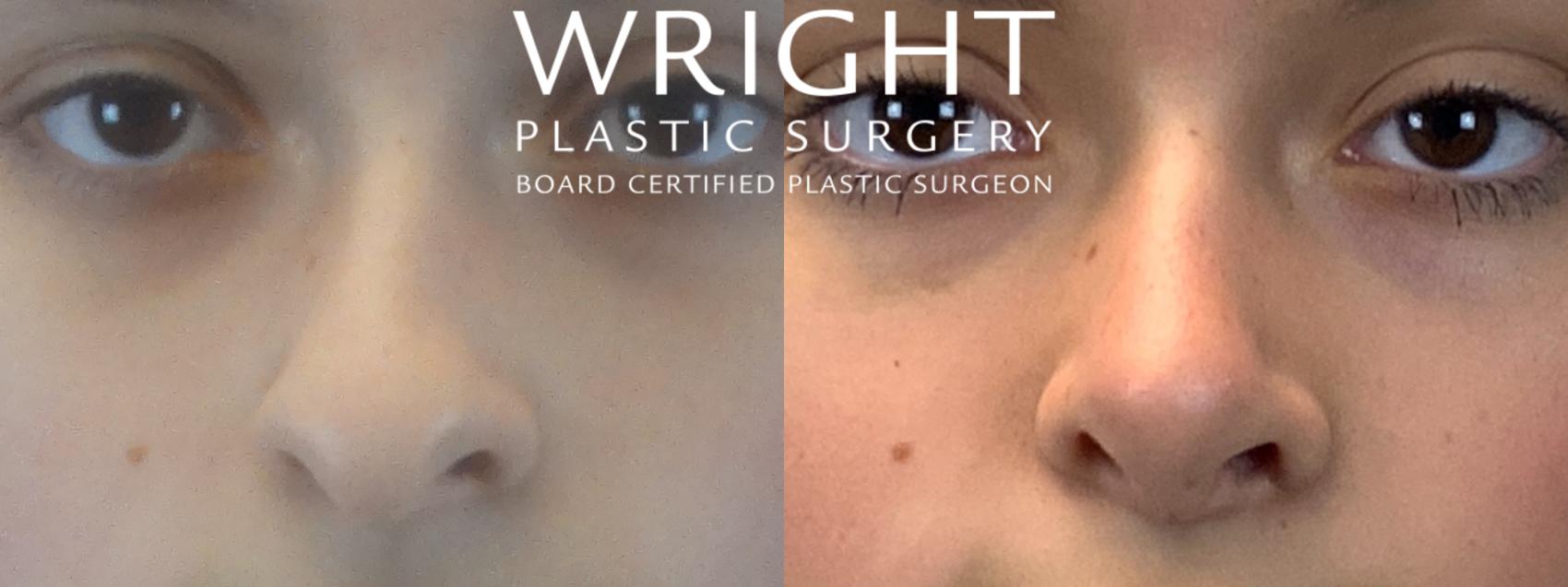 Before & After Rhinoplasty Case 145 Front View in Little Rock, Arkansas