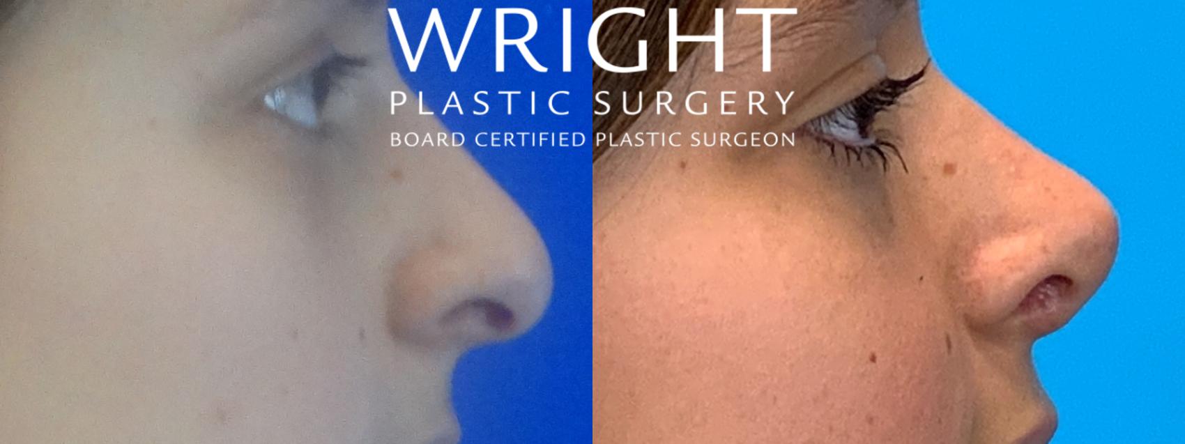 Before & After Rhinoplasty Case 145 Right Side View in Little Rock, Arkansas
