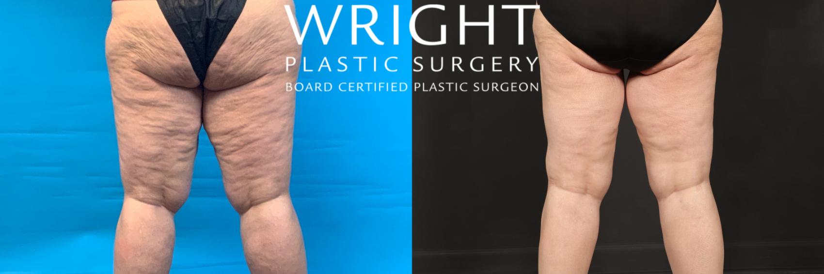 Before & After Thigh Lift Case 402 Back View in Little Rock, Arkansas