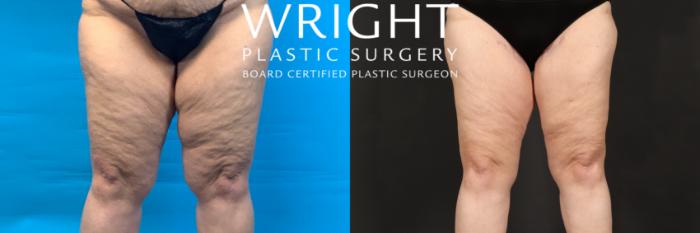 Before & After Liposuction Case 402 Front View in Little Rock, Arkansas