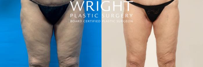 Before & After Thigh Lift Case 408 Front View in Little Rock, Arkansas
