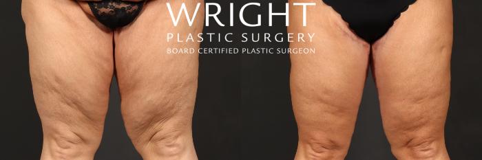 Before & After Thigh Lift Case 559 Front View in Little Rock, Arkansas