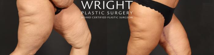 Before & After Thigh Lift Case 559 Right Side View in Little Rock, Arkansas