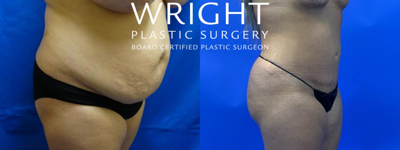 Before & After Liposuction Case 108 Right Oblique View in Little Rock, Arkansas