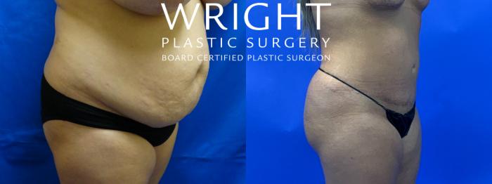Before & After Tummy Tuck Case 108 Right Oblique View in Little Rock, Arkansas