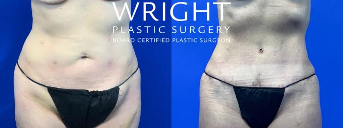 Before & After Tummy Tuck Case 115 Front View in Little Rock, Arkansas