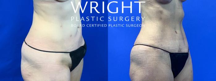 Before & After Tummy Tuck Case 115 Right Oblique View in Little Rock, Arkansas