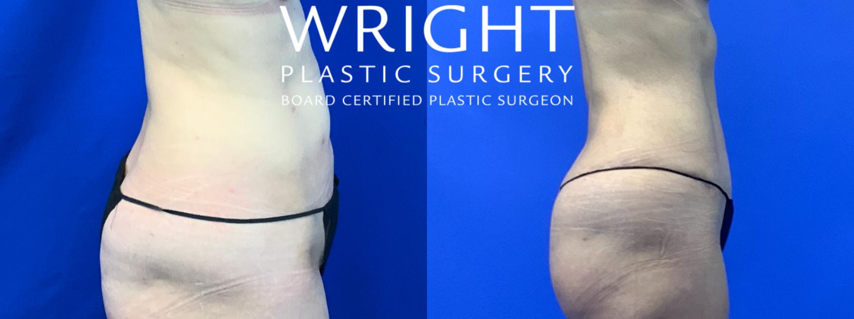 Before & After Tummy Tuck Case 115 Right Side View in Little Rock, Arkansas