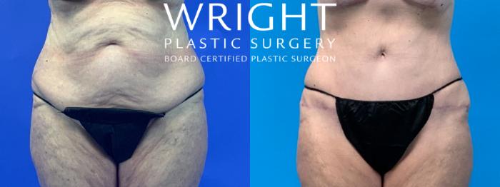 Before & After Tummy Tuck Case 122 Front View in Little Rock, Arkansas