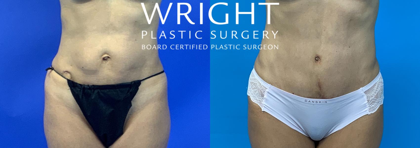 Tummy Tuck Austin