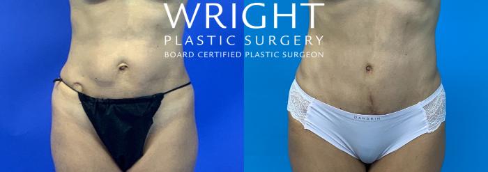 Before & After Tummy Tuck Case 132 Front View in Little Rock, Arkansas