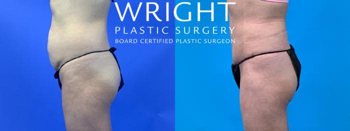 Before & After Tummy Tuck Case 144 Left Side View in Little Rock, Arkansas